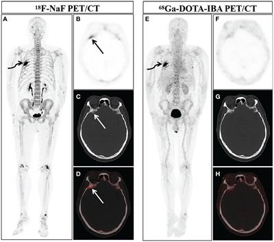 Comparison of the relative diagnostic performance of 68Ga-DOTA-IBA and 18F-NaF for the detection of bone metastasis